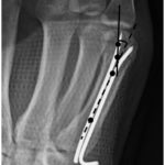 Fractures of the 5th metacarpal neck (Boxer