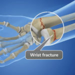 Surgery for a wrist fracture is not always necessary