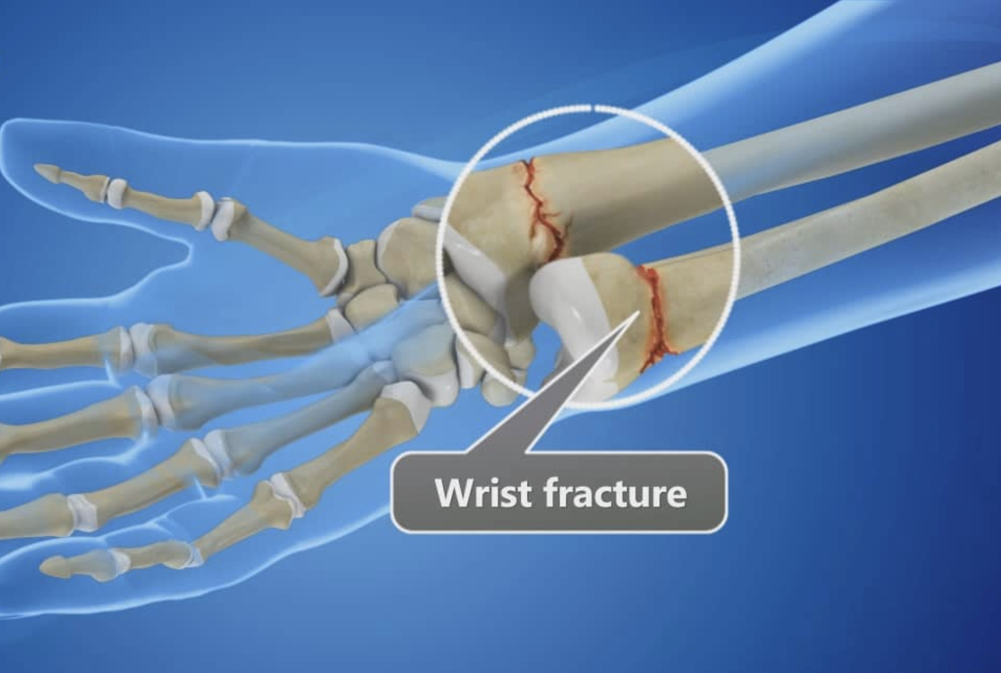 Wrist fracture